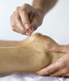 En behandler sætter akupunkturnåle i en fod